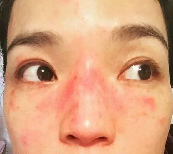 敏感肌肤用什么护肤品?教你敏感肌正确的护肤步骤